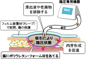 陰圧創傷治療システムの模式図