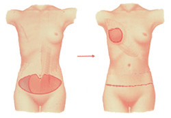腹直筋による乳房再建術