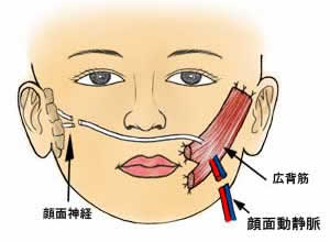 広背筋移植による「笑い表情」の再建手術方法