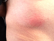 ワクチン注射を打った腹部写真