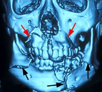 顔面骨折３DCT