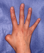 切断指再建術（右手親指欠損の術前）