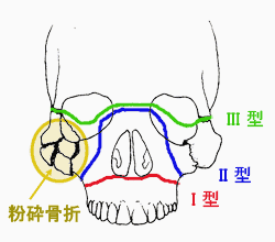 顔面骨折のイラスト
