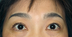腱膜性眼瞼下垂症（術後）