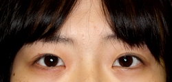 先天性眼瞼下垂症（術後）