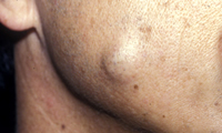 皮膚腫瘍写真