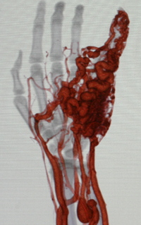 動静脈奇形のCT血管造影写真