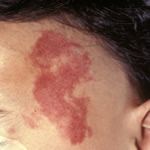 単純性血管腫(赤アザ）の写真