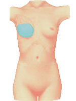 乳房インプラント模式図