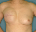 乳房インプラント症例２