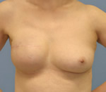 乳房インプラント症例３