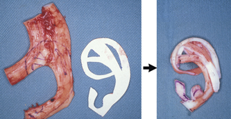 小耳症　自家軟骨移植