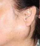 耳下腺腫瘍症例写真